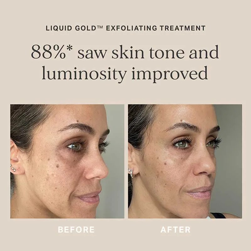 Alpha-H Liquid Gold Exfoliating Treatment with 5% Glycolic Acid & Vitamin B Serum